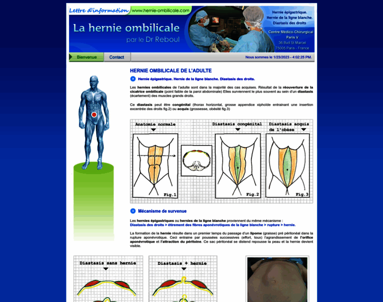 Hernie-ombilicale.com thumbnail