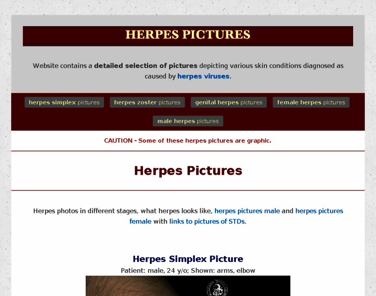 Herpes-coldsores-treatment-pictures.com thumbnail