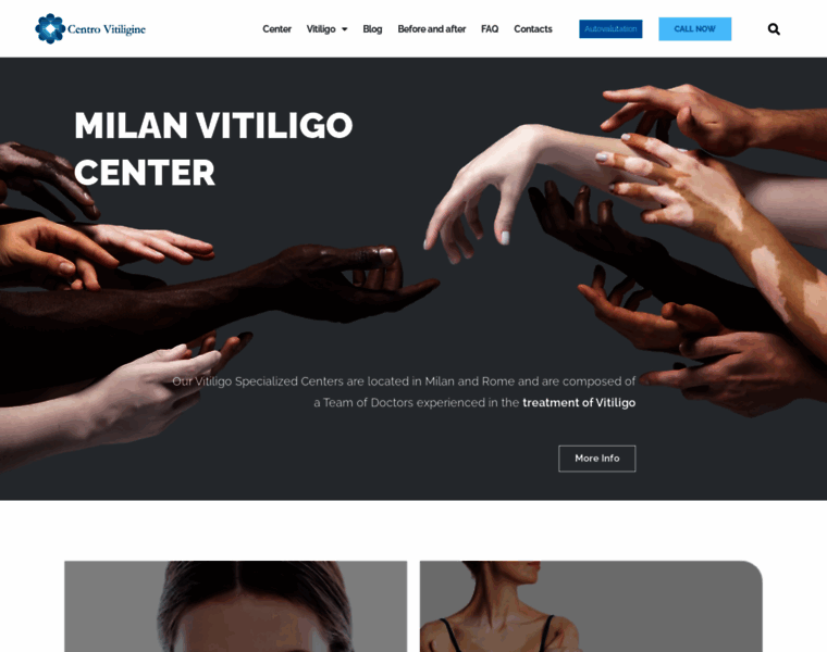 Vitiligo.com thumbnail