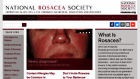 What Rosacea.org website looked like in 2018 (5 years ago)